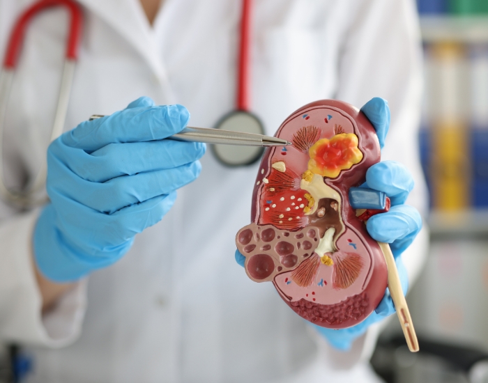 Chronic Fatigue and Kidney Disease Concerns: Understanding the Link