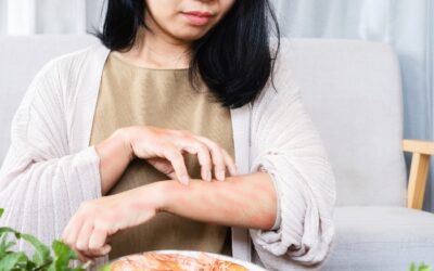 Frequent Hives After Meals: Causes, Symptoms, and When to Seek Help