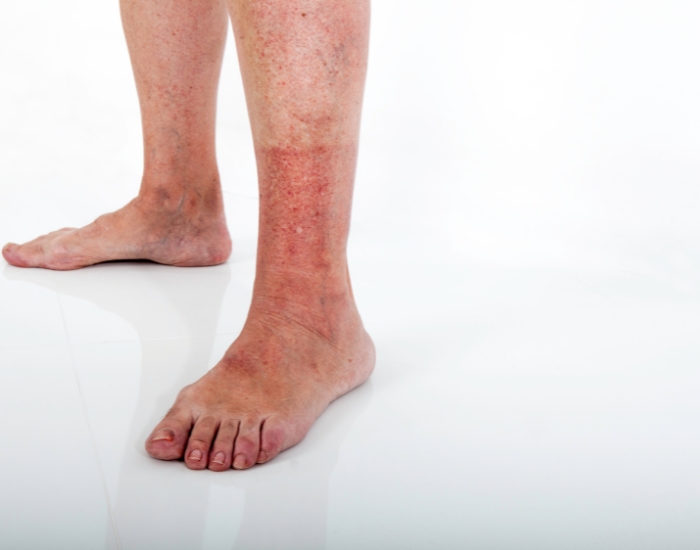 Foot and mouth disease